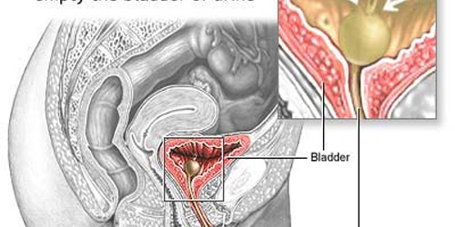 Enlarged-prostate