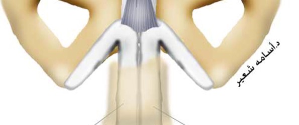 Penis-curvature