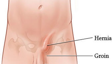 Testicular-congestion