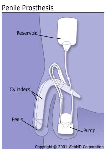 penile prothesis