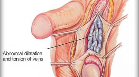 Varicocele Varicocele