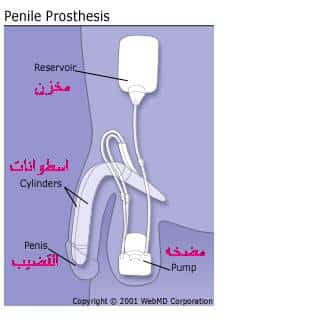 prothesis